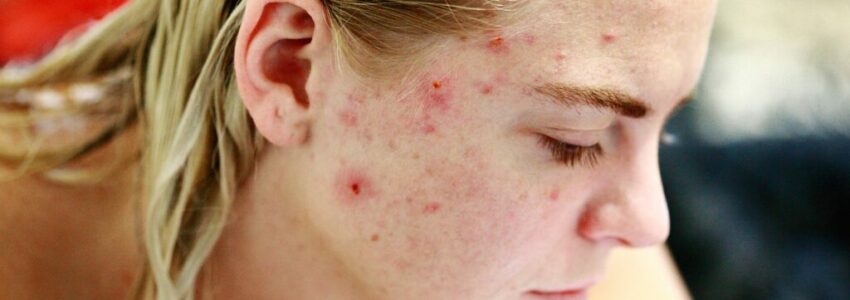 Side portrait of a woman with acne