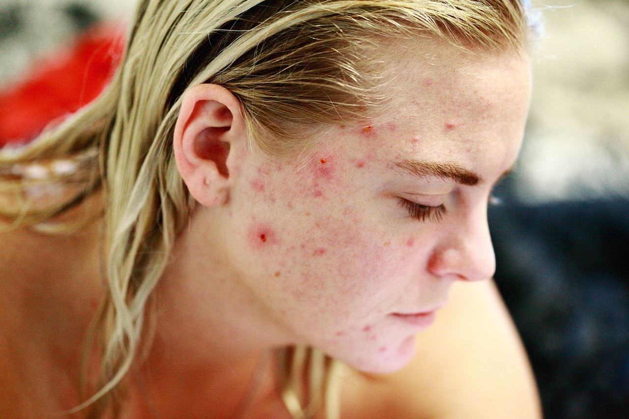 A woman having acne on her face wanting a probiotics for cure