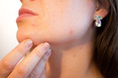 Side face profile of a woman with acne