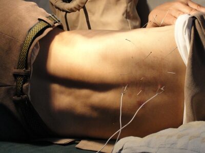 A man's back with needles during an acupuncture session