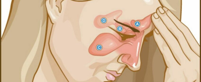 An illustration of a woman suffering from sinus infection.