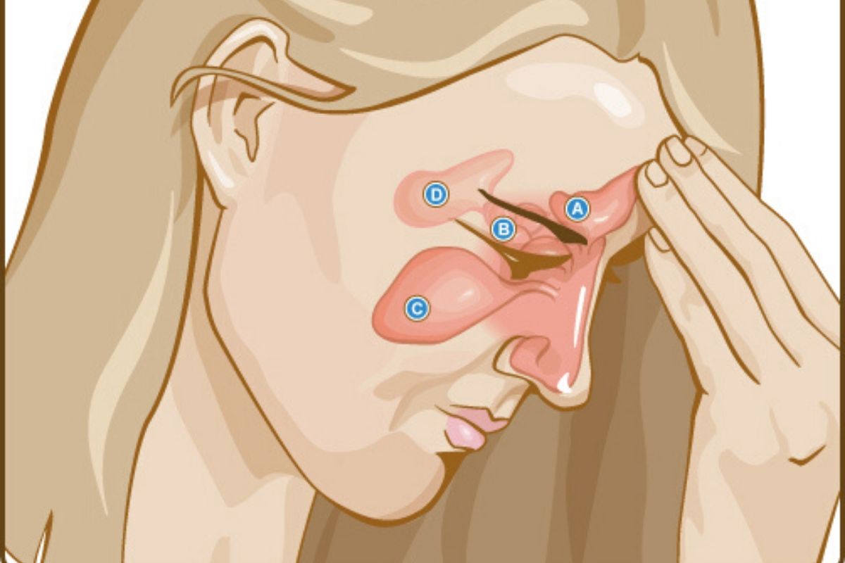 An illustration of a woman suffering from sinus infection.