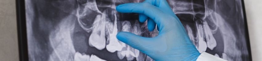 X-ray copy of teeth of the patient that has a sinus infection