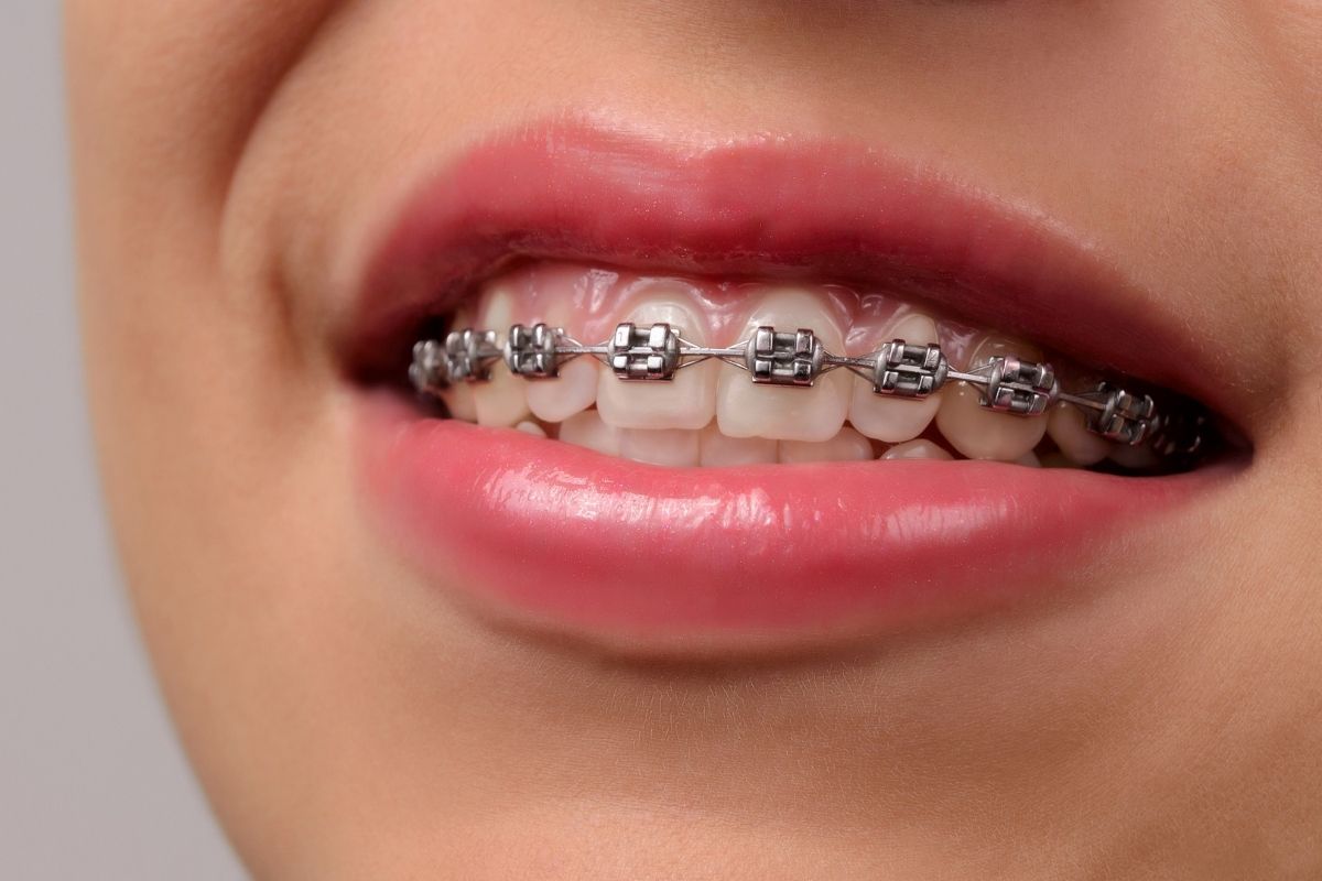 A woman suffering from braces stains.