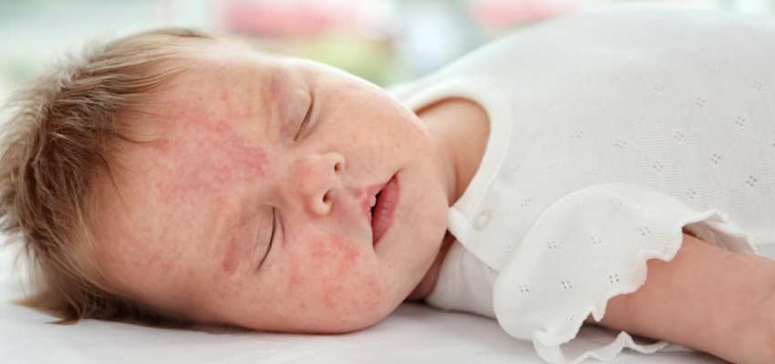 A sleeping baby with rashes on the face.