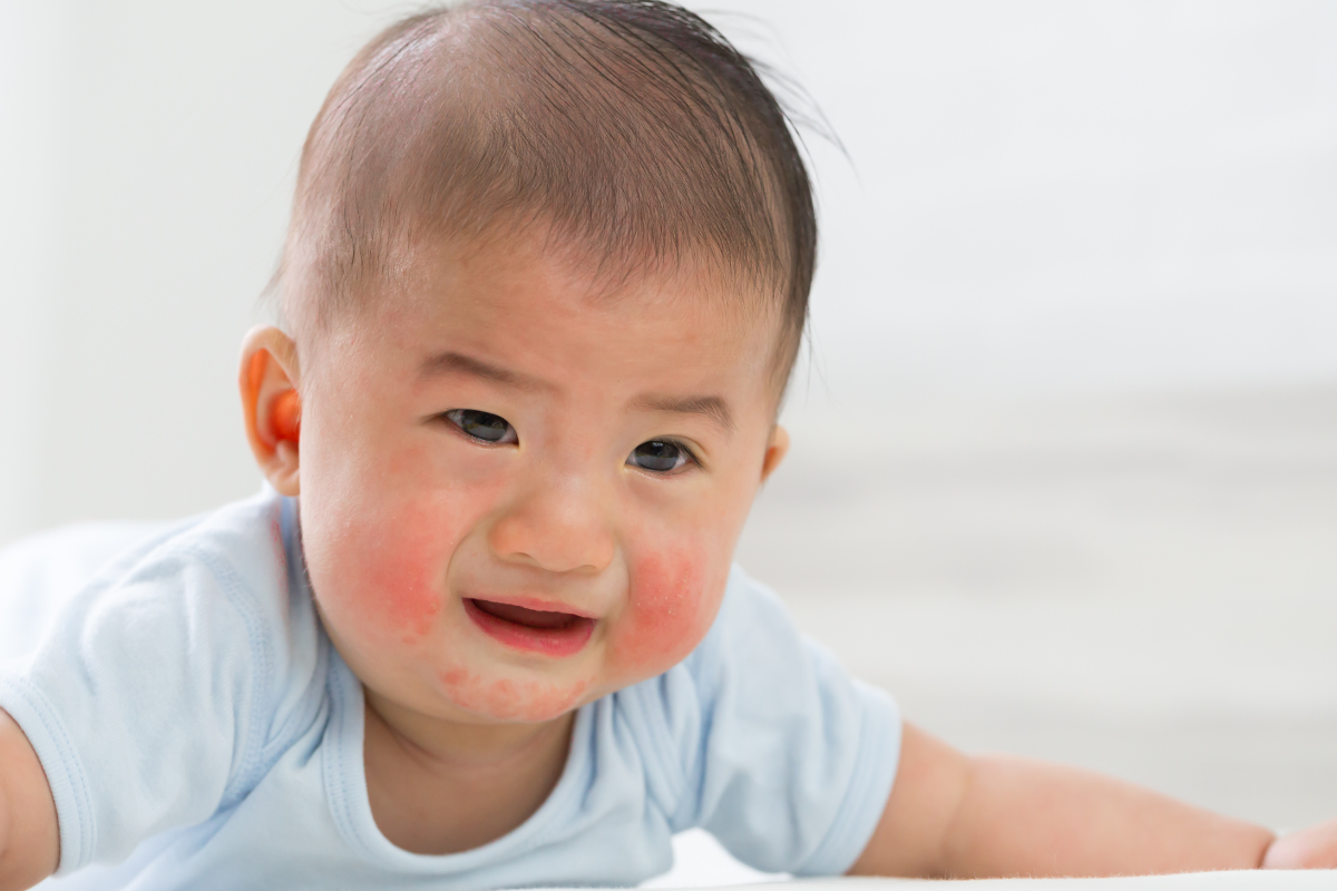 A baby crying while suffering from eczema.