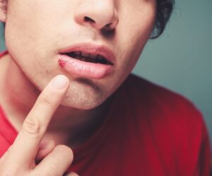 A man wonders why he gets stomatitis.