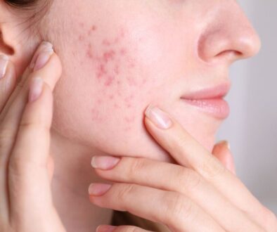 The woman shows acne on her cheek.
