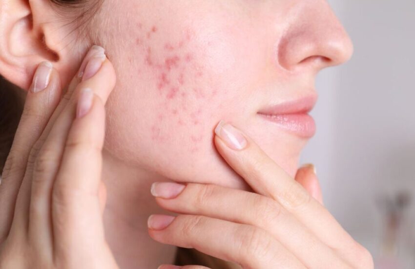 The woman shows acne on her cheek.