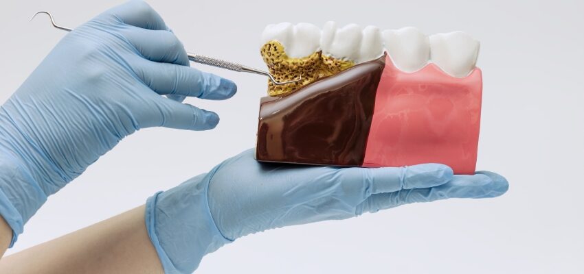 Periodontal disease is characterized by the inflammation and infection of the gums and bone responsible for your teeth.