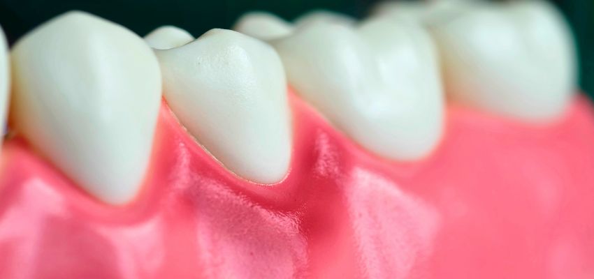 Close-up of inflamed gums that can cause the odor in what does gingivitis smell like.